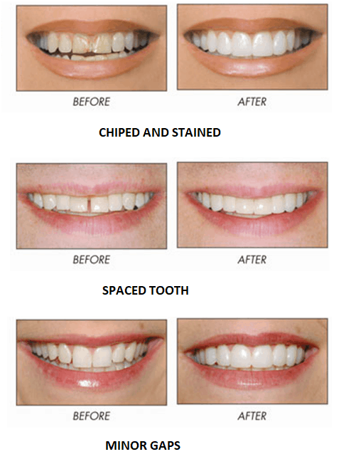 Advanced professional laser teeth whitening session