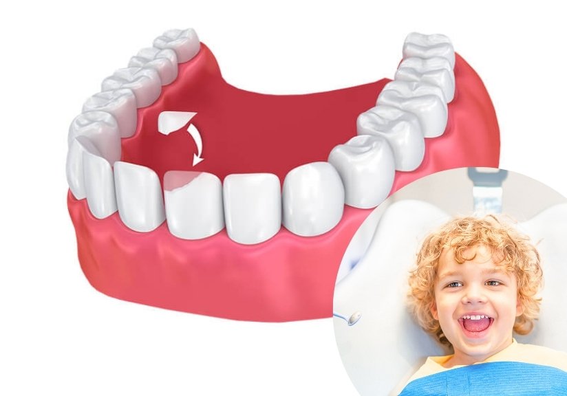 Advanced professional laser teeth whitening session