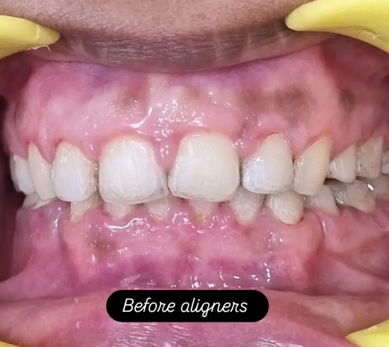 Tooth Before Dental Aligners Treatment