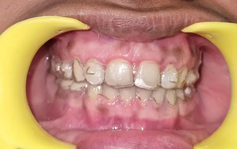 Tooth After Dental Aligners Treatment