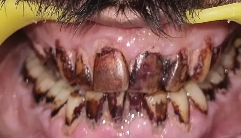 Teeth Before Whitening Treatment