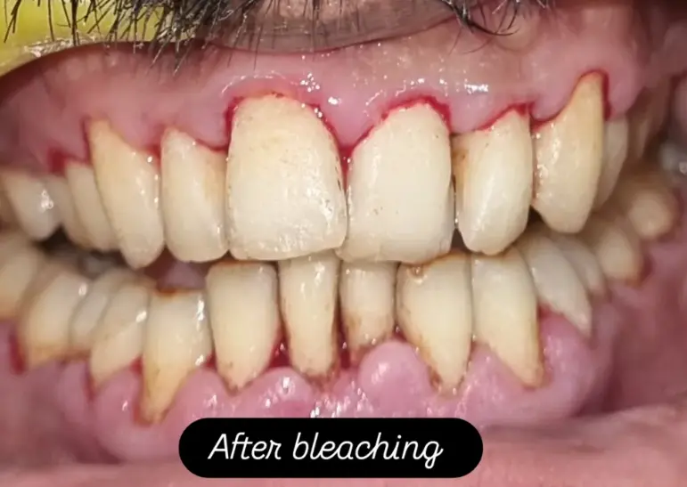 Teeth After Whitening Treatment