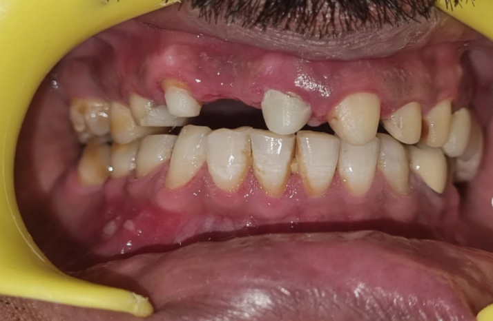 Teeth Before Dental Bridge Treatment
