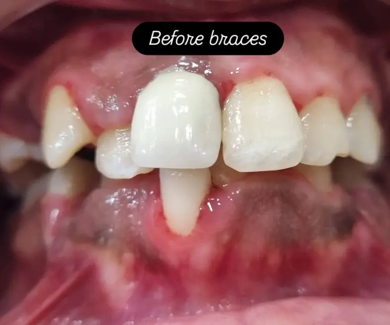 Teeth Before Braces Treatment