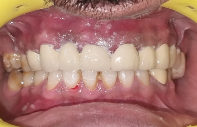 Teeth After Dental Bridge Treatment