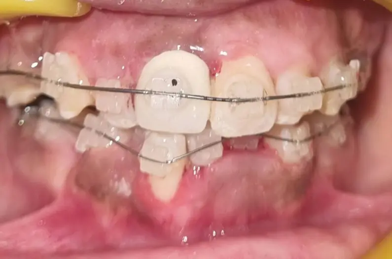 Teeth After Braces Treatment