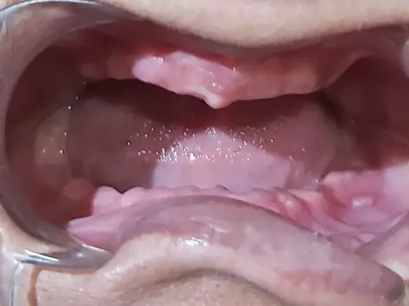Teeth Before Denture Treatment