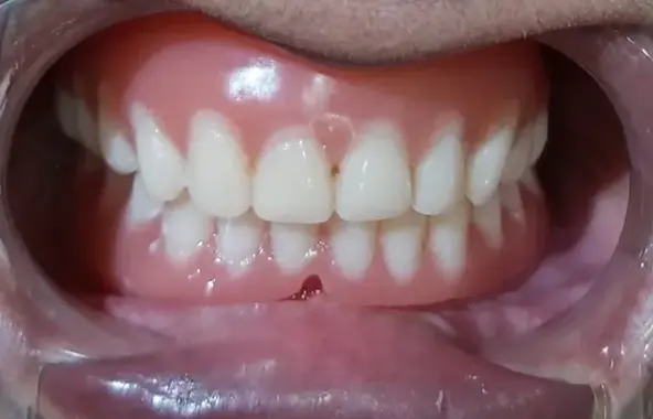 Teeth After Denture Treatment