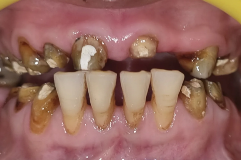Teeth Before Denture Treatment