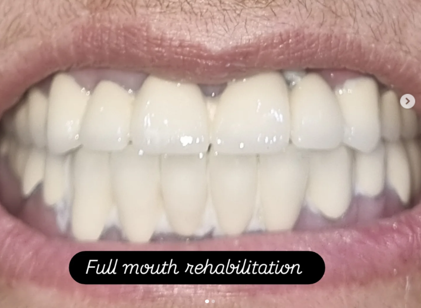 Teeth After Denture Treatment